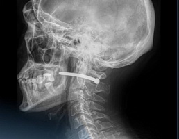 Выстрелил гвоздем в шею: 51-летний мужчина случайно поранил себя во время ремонта